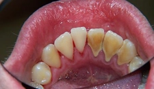 Diş Taşı Özellikleri ve Faydaları Nelerdir?