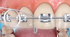 Diş Teli Bakımı Nasıl Yapılır?